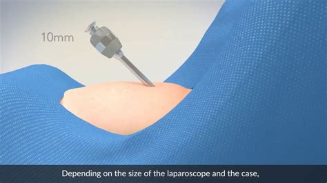 the needle drop testing|Principles of safe abdominal entry in laparoscopic gynecologic .